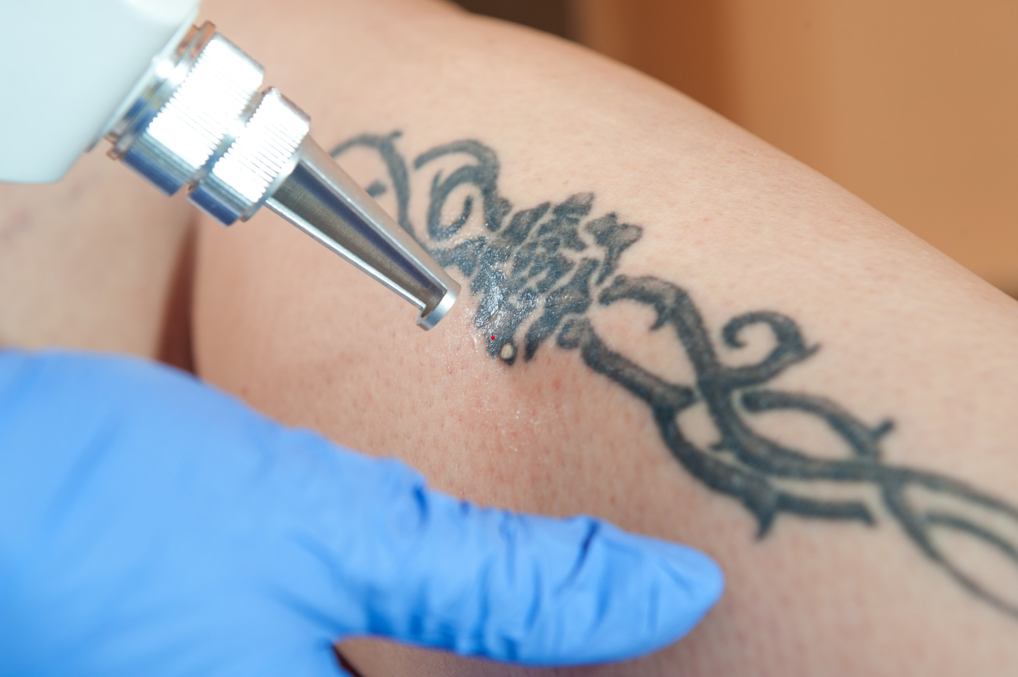 Tattoo Removal courses - Cademy